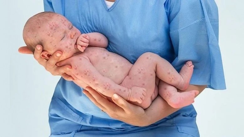 Kızamık vakaları artmaya başladı