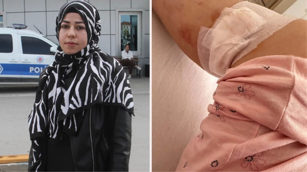 Sokak köpekleri işe giden genç mühendisi bacağından ısırdı