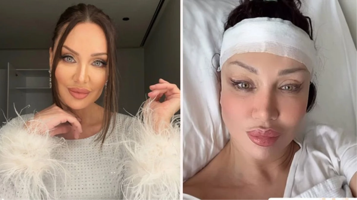 Alın daraltma ameliyatı olmuştu! Umut Akyürek’in son haline beğeni yağdı