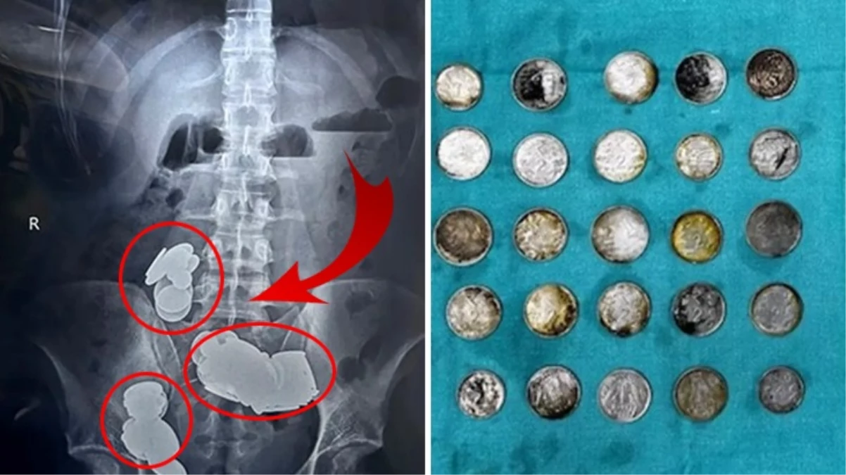Hindistan’da çinkonun vücut geliştirdiğini düşünen halterci, 39 madeni para ve 37 mıknatısı yuttu