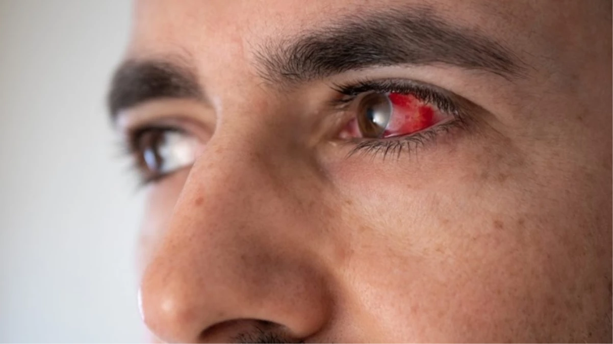 Paris’te gözlerden ve ağızdan kan gelmesine neden olan Lassa ateşi vakası tespit edildi