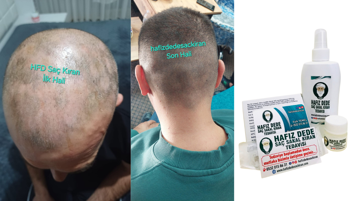 Hafız Dede Saç Kıran Tedavisi: Doğadan Gelen Güçlü Şifa, Yıllara Meydan Okuyor