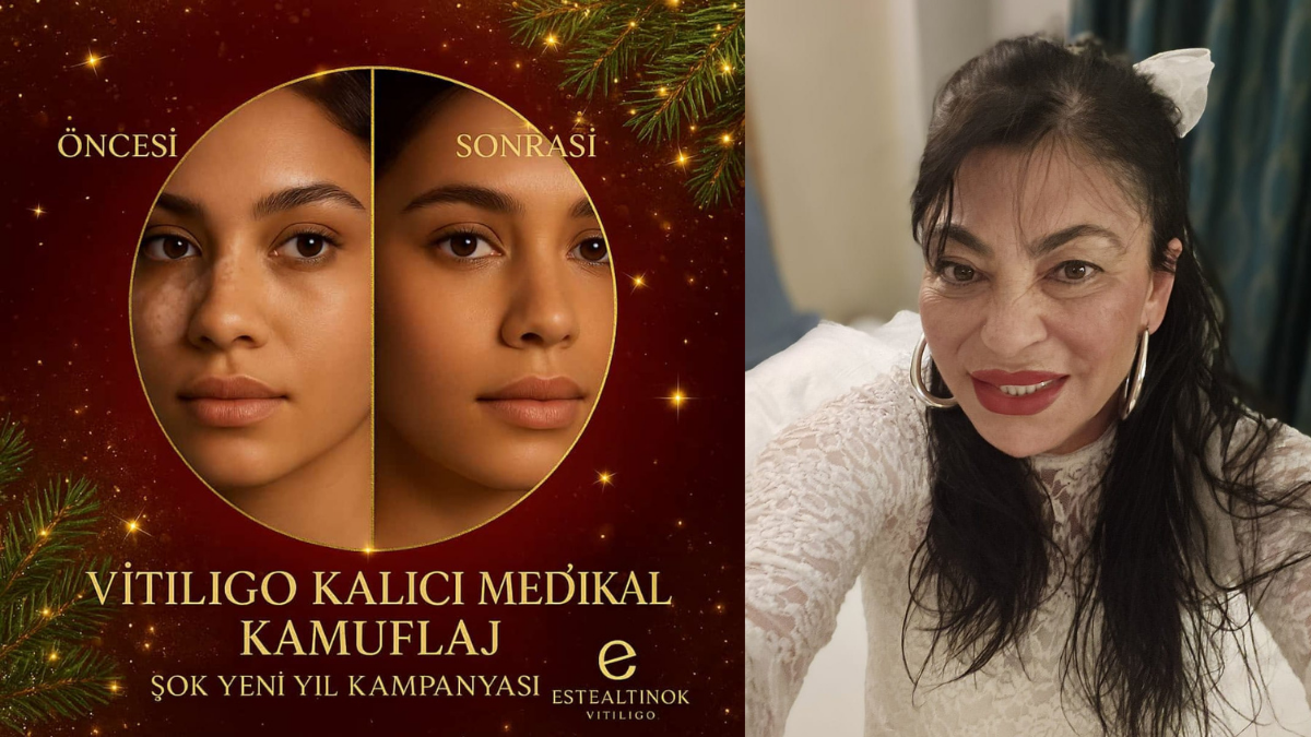 Cildindeki İzlerle Vedalaşanlar Anlatıyor: İkbal Yeşil’den Medikal Kamuflaj Mucizesi