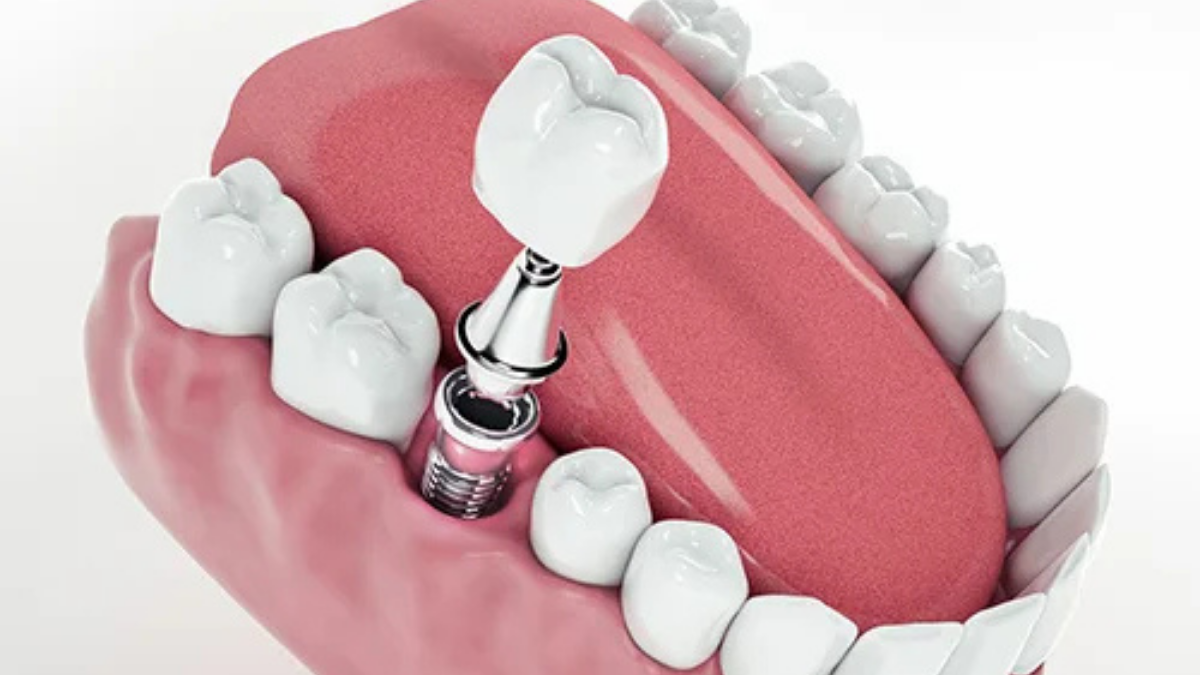 Türkiye’de Diş Hekimliğinde Yenilik: Apexcore İmplant ile Hızlı ve Estetik Çözümler